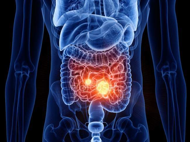 Corpo masculino abstrato com câncer de intestino delgado, ilustração computacional . — Fotografia de Stock