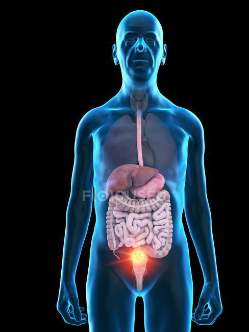 Digital illustration of senior man anatomy showing digestive tumour. — Stock Photo