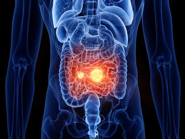 Corpo masculino abstrato com câncer de intestino delgado, ilustração computacional . — Fotografia de Stock