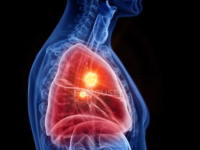 Абстрактний силует самця з раком легенів, цифровий приклад. — стокове фото