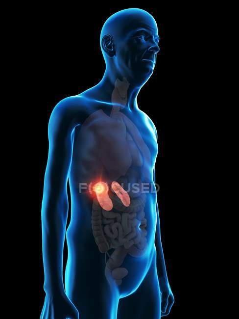 Ilustração digital da anatomia do homem sênior mostrando tumor renal
. — Fotografia de Stock