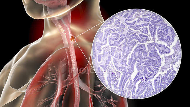 Cancer de l'œsophage, illustration par ordinateur et micrographie photonique des tissus cancéreux . — Photo de stock