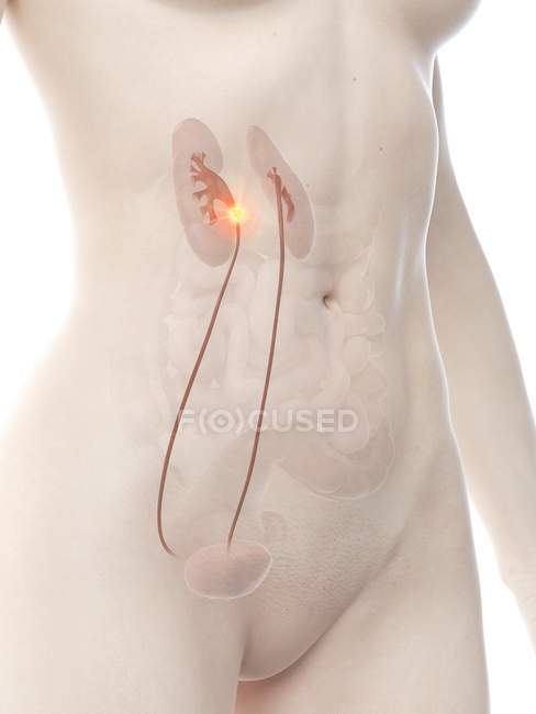 Anatomical female body with ureteral cancer, conceptual digital illustration. — Stock Photo
