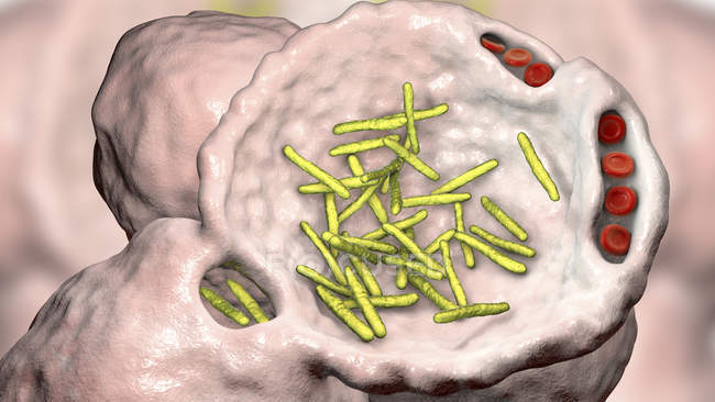 Computerillustration von stäbchenförmigen Bakterien innerhalb der Lungenbläschen, die Infektionen der unteren Atemwege und bakterielle Lungenentzündung verursachen. — Stockfoto