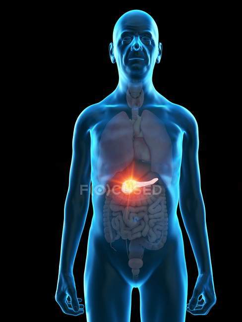 Цифрова ілюстрація пухлини підшлункової залози літньої людини . — стокове фото