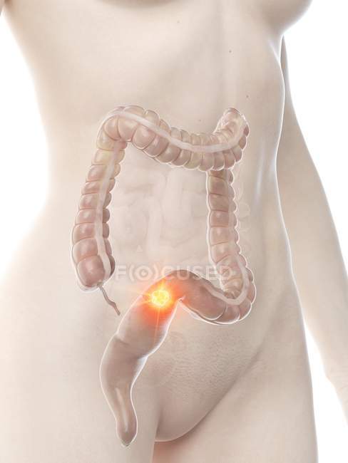 Female body with colon cancer, conceptual digital illustration. — Stock Photo