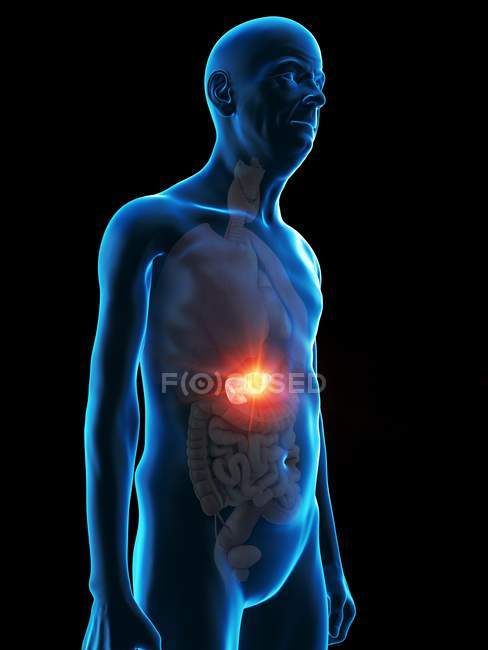 Цифрова ілюстрація пухлини підшлункової залози. — стокове фото