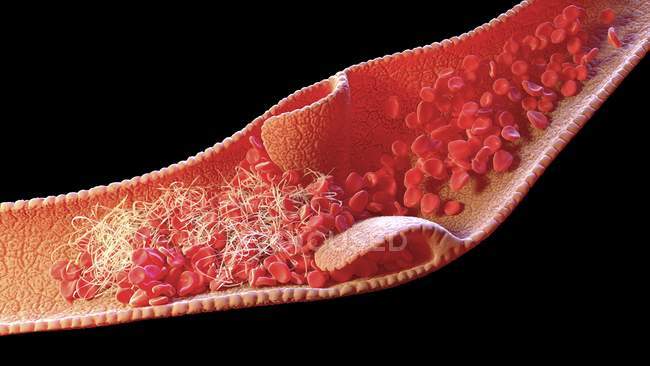 Изображение кровяного клота внутри сосудов, известного как венозное горло. — стоковое фото