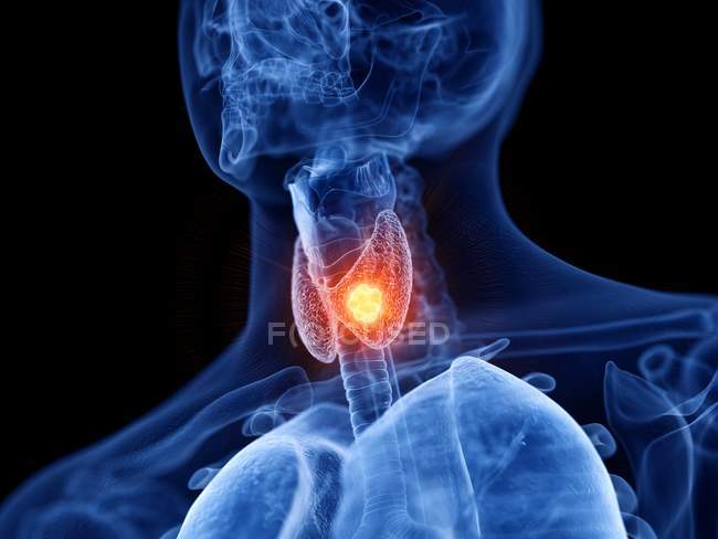 Cuerpo masculino transparente abstracto con cáncer de tiroides brillante, ilustración digital . - foto de stock