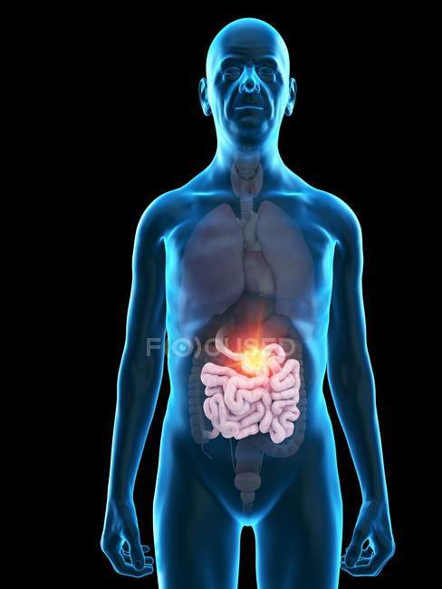 Ilustração digital da anatomia do homem sênior mostrando tumor do intestino delgado . — Fotografia de Stock