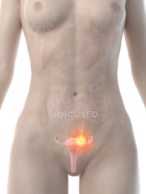 Анатомічне жіноче тіло з раком матки, концептуальна комп'ютерна ілюстрація. — стокове фото