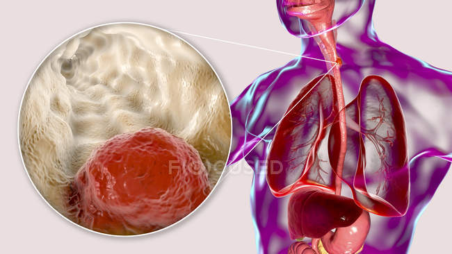 Câncer esofágico, ilustração digital composta com corpo humano e células cancerígenas
. — Fotografia de Stock