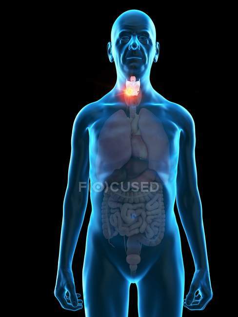 Ilustración digital de la anatomía del hombre mayor que muestra tumor de laringe . - foto de stock