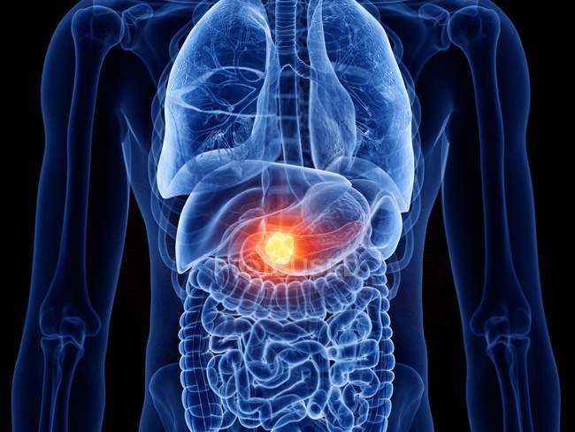 Cancro al pancreas nel corpo maschile, illustrazione al computer . — Foto stock