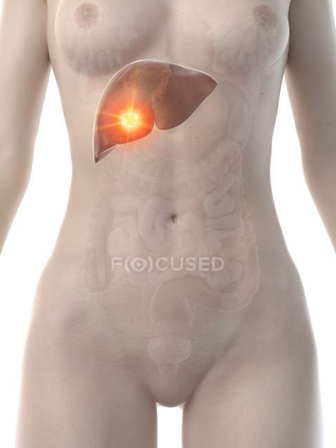 Corpo femminile con cancro al fegato, illustrazione concettuale del computer . — Foto stock