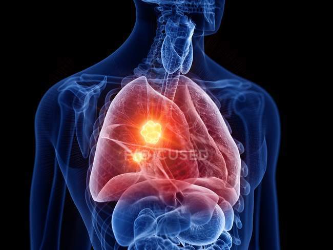 Абстрактный мужской силуэт с раком легких, цифровая иллюстрация
. — стоковое фото