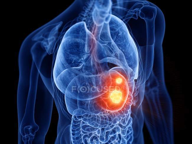 Cuerpo masculino transparente abstracto con cáncer de estómago brillante, ilustración digital . - foto de stock