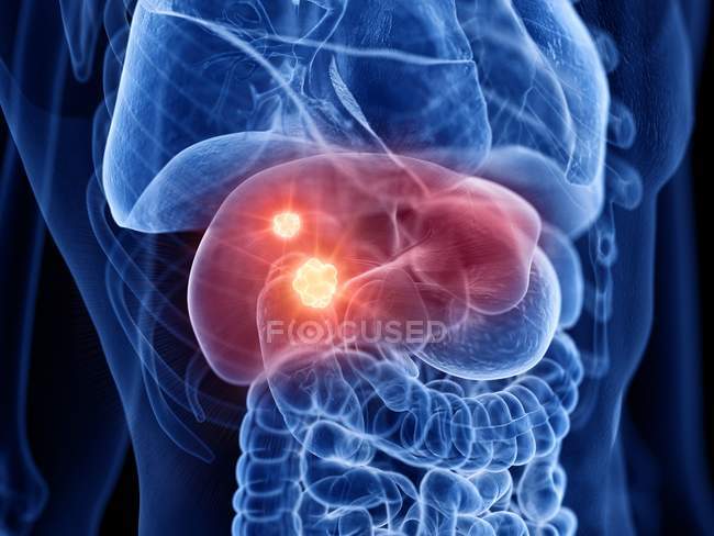 Corpo maschile trasparente con cancro al fegato, illustrazione digitale . — Foto stock
