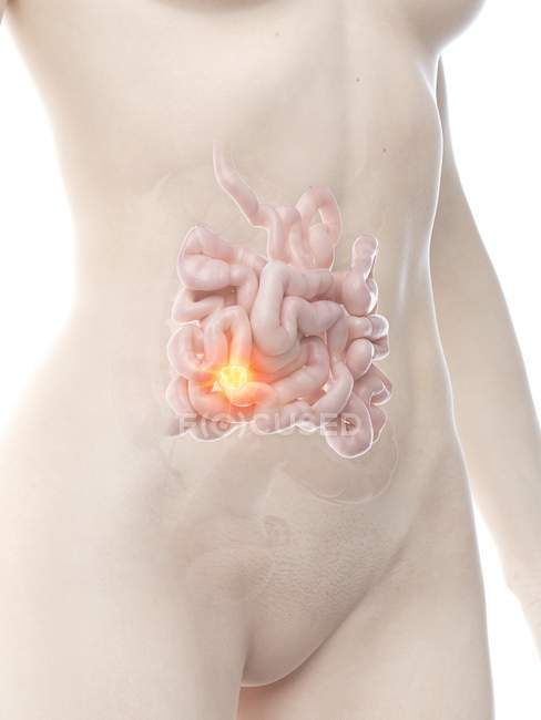 Corpo feminino com câncer de intestino delgado, ilustração conceitual do computador . — Fotografia de Stock
