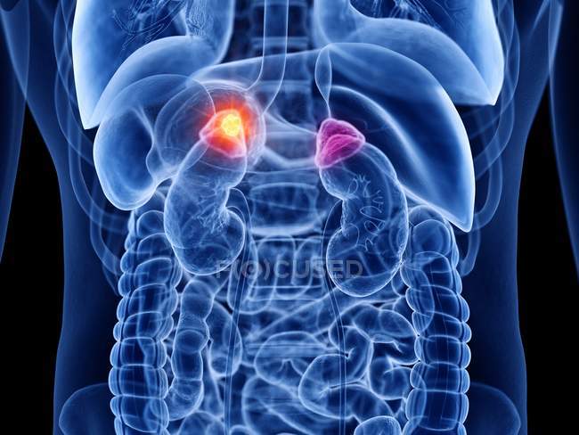 Transparent male body with adrenal gland cancer, computer illustration. — Stock Photo
