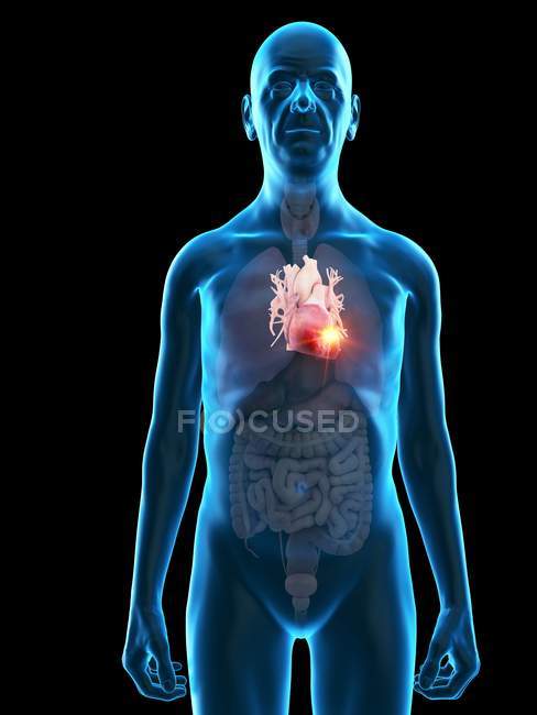 Цифрова ілюстрація анатомії старшого чоловіка, що показує пухлину серця . — стокове фото
