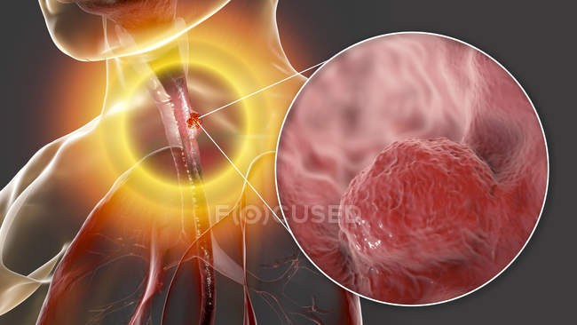 Cáncer de esófago, ilustración digital compuesta con cuerpo humano y células cancerosas . - foto de stock