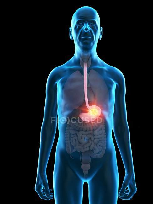 Illustration numérique de l'anatomie de l'homme âgé montrant une tumeur à l'estomac . — Photo de stock