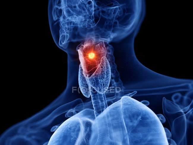 Corps masculin transparent abstrait avec cancer du larynx lumineux, illustration numérique . — Photo de stock