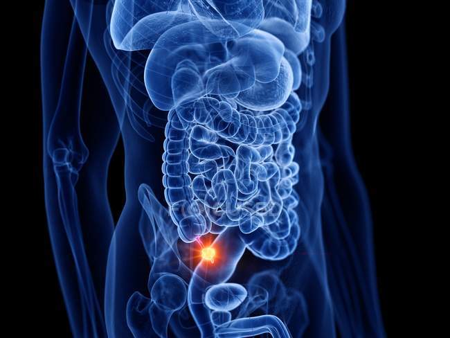 Абстрактное мужское тело с раком аппендикса, компьютерная иллюстрация
. — стоковое фото