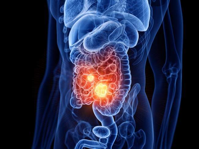 Corpo maschile astratto con cancro all'intestino tenue, illustrazione al computer . — Foto stock