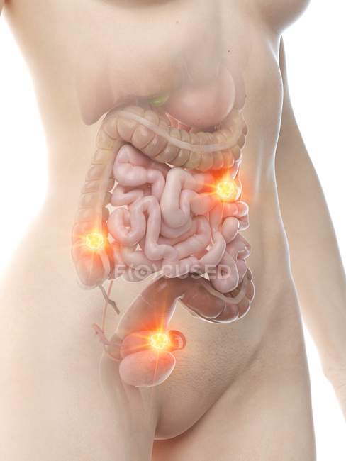 Cuerpo femenino con metástasis de cáncer en el abdomen, ilustración conceptual por computadora
. - foto de stock