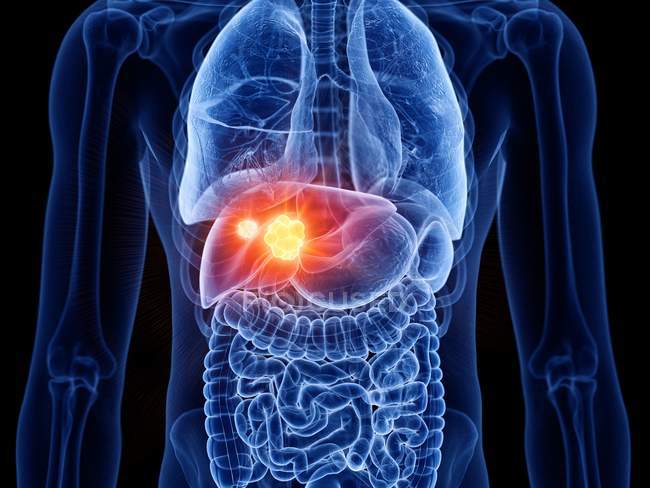 Corpo masculino transparente com câncer de fígado, ilustração digital
. — Fotografia de Stock