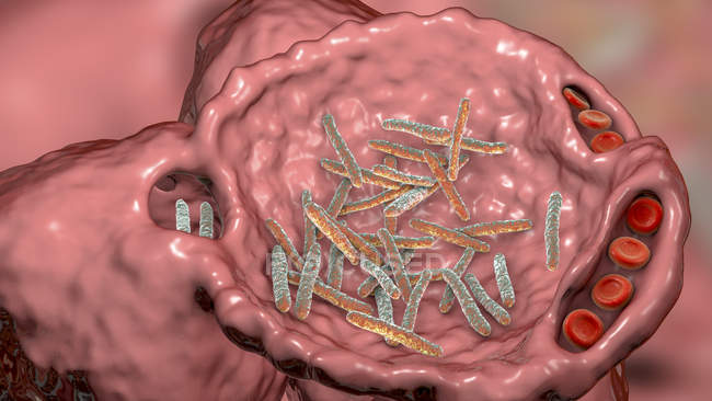 Computer illustration of rod-shaped bacilli bacteria inside alveolus of lung, causing lower respiratory tract infection and bacterial pneumonia. — Stock Photo