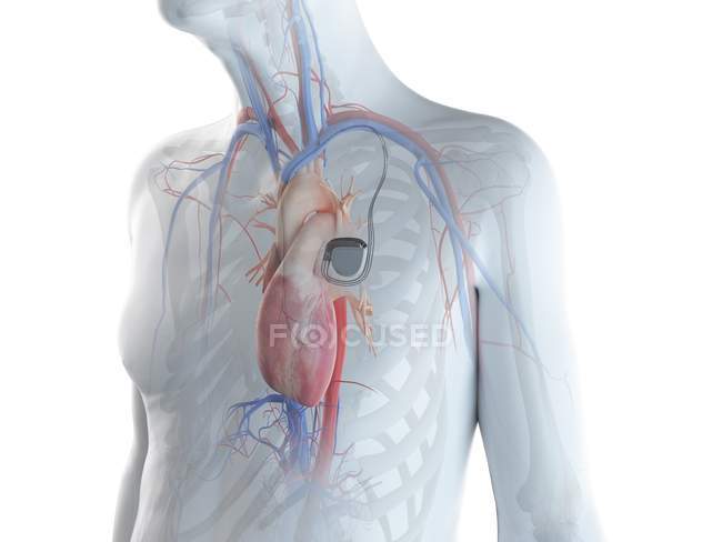 Medical digital illustration of senior man with cardiac pacemaker in heart. — Stock Photo