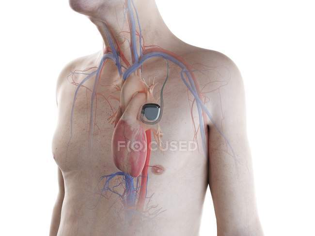 Illustrazione digitale medica di uomo anziano con pacemaker cardiaco nel cuore . — Foto stock