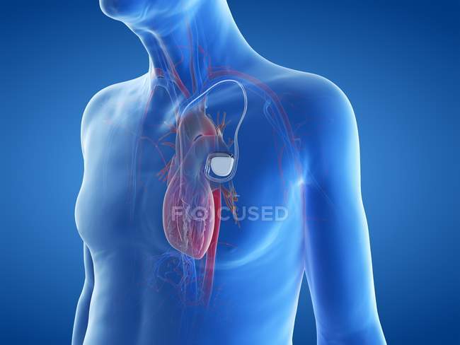 Medical digital illustration of senior man with cardiac pacemaker in heart. — Stock Photo