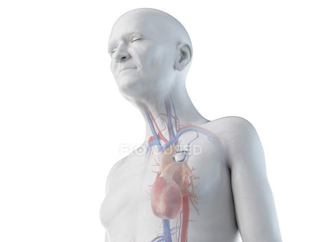 Illustration numérique médicale d'un homme âgé avec stimulateur cardiaque au cœur . — Photo de stock