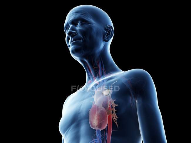 Медична цифрова ілюстрація чоловіка старшого віку з кардіостимулятором в серці. — стокове фото