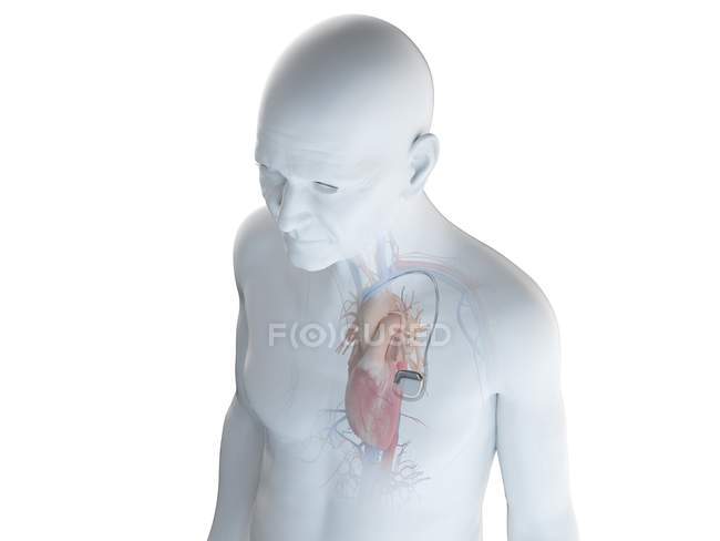 Medizinische digitale Illustration eines älteren Mannes mit Herzschrittmacher im Herzen. — Stockfoto