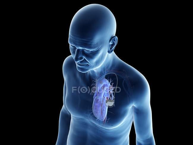 Illustration numérique médicale d'un homme âgé avec stimulateur cardiaque au cœur . — Photo de stock
