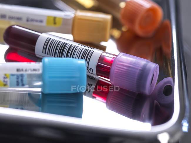 Primo piano del sangue umano e di vari campioni medici nelle provette durante lo screening in laboratorio medico . — Foto stock