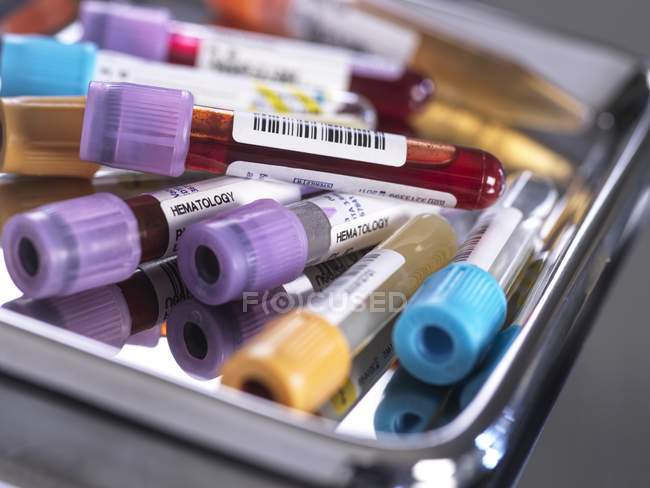Gros plan du sang humain et de divers échantillons médicaux dans les éprouvettes lors du dépistage en laboratoire médical . — Photo de stock
