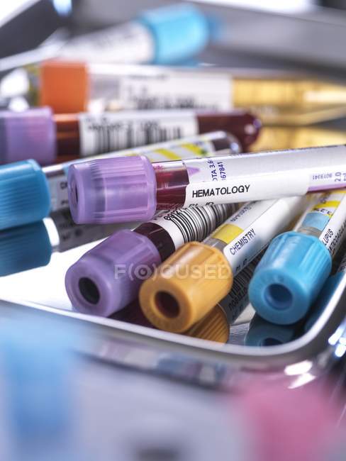 Primo piano del sangue umano e vari campioni ematologici nelle provette durante lo screening in laboratorio medico . — Foto stock
