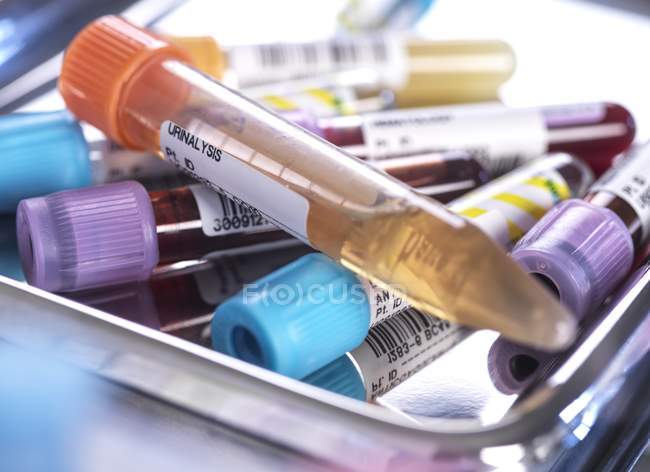 Primer plano de la orina humana, la sangre y varias muestras médicas en los tubos de ensayo mientras se realizan pruebas de detección en el laboratorio médico
. - foto de stock