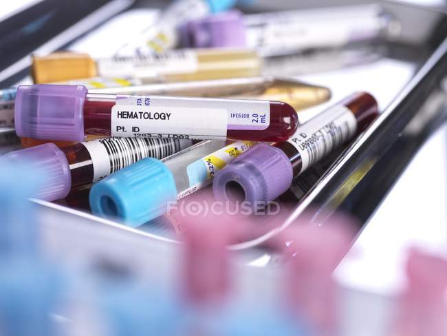 Primer plano de la sangre humana y varias muestras médicas en tubos de ensayo durante el cribado en laboratorio médico
. - foto de stock