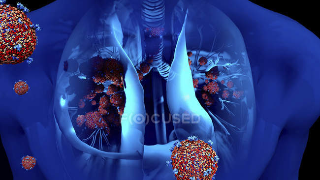Konzeptionelle Illustration von Coronavirus-Partikeln in der menschlichen Lunge. — Stockfoto