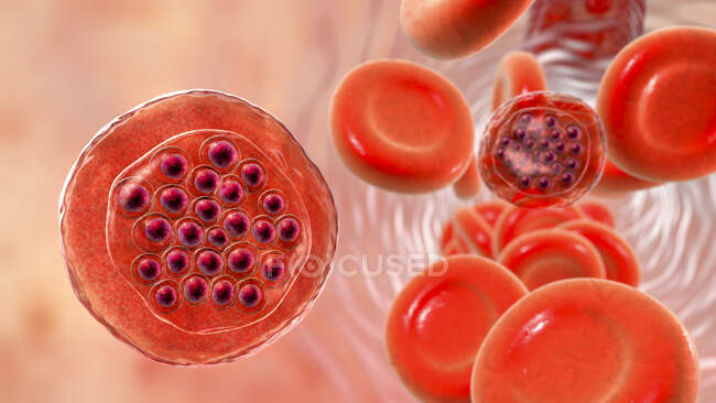 Plasmodium falciparum protozoan внутри эритроцитов, компьютерная иллюстрация — стоковое фото