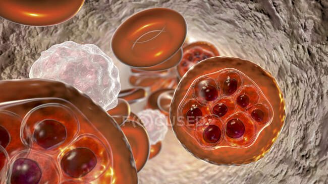 Кровоносні клітини і плазмодія. паразити (на етапі шизонів) спричиняють малярію, комп 