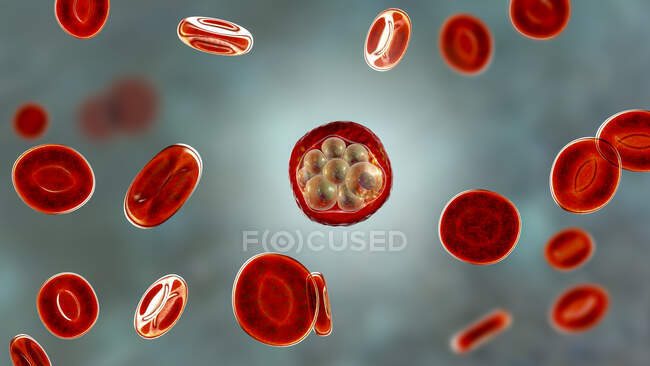 Glóbulos sanguíneos y Plasmodium sp. parásitos (en la etapa de esquizontes) que causan malaria, ilustración por computadora
. - foto de stock