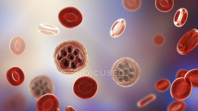 Glóbulos sanguíneos y Plasmodium sp. parásitos (en la etapa de esquizontes) que causan malaria, ilustración por computadora . - foto de stock